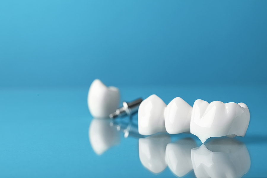 Everything to Know About Dental Crowns